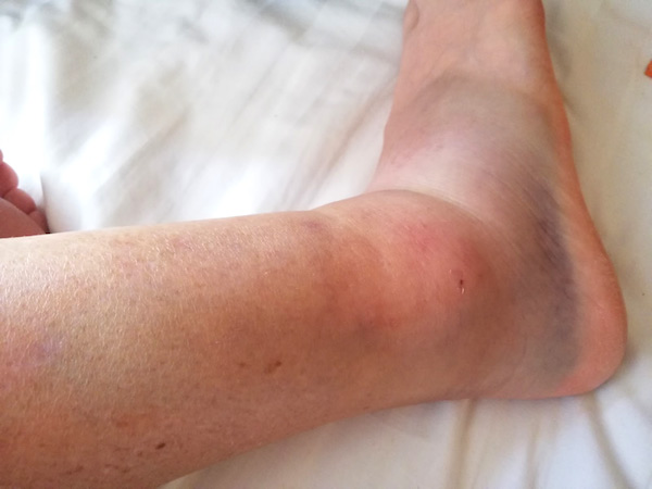 Swollen and sprained ankle – Everest in Trainers Sprained ankles as a result of wearing trainers on everest base camp trek